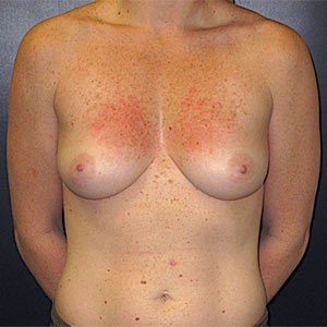 Nipple Sparing Surgery, Nipple Sparing Mastectomy, Charleston SC
