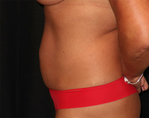 Tummy Tuck